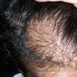 Xin hãy đánh giá kết quả cấy tóc của tôi, tôi cấy tóc từ 6 tháng trước