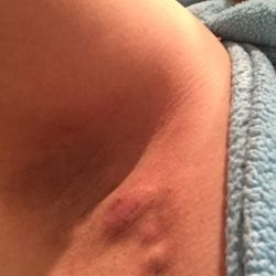 Tại sao nách tôi vẫn có các cục u 2 tháng sau điều trị bằng Miradry?