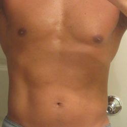 Vì sao tôi lại bị sưng ở phần eo/ngực sau khi điều trị bằng MiraDry?