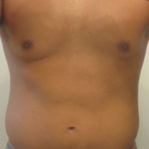 Vì sao tôi lại bị sưng ở phần eo/ngực sau khi điều trị bằng MiraDry?