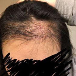 Cấy tóc thất bại, tôi nên làm gì để chỉnh sửa?