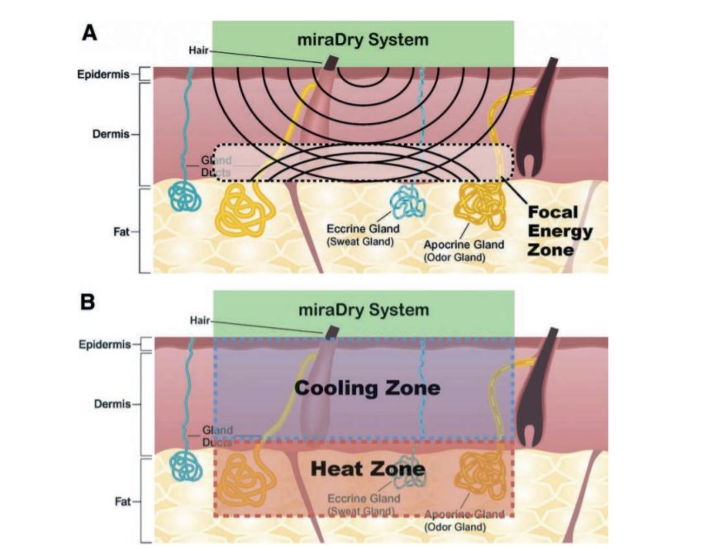 Tác dụng và rủi ro của công nghệ vi sóng MiraDry trong điều trị hôi nách và chứng tăng tiết mồ hôi
