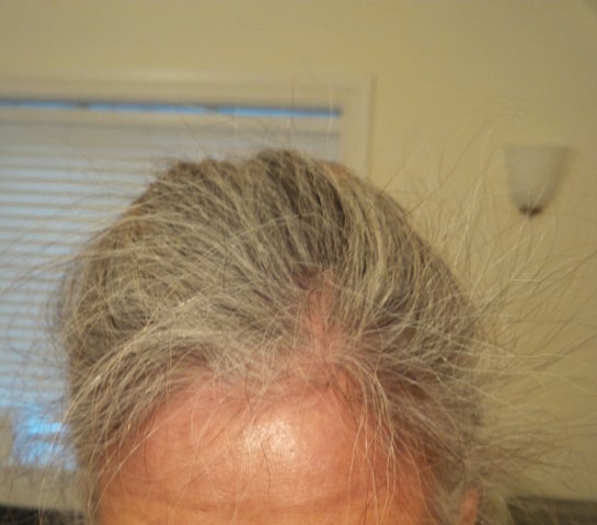 Rụng tóc từng mảng Alopecia Areate