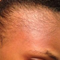 Tiêm cortisone có thể chữa rụng tóc không hay chỉ có thể làm cấy tóc?