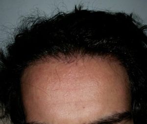 Cần bao nhiêu lâu để tóc mọc toàn bộ và có cần phải cắt tóc không?