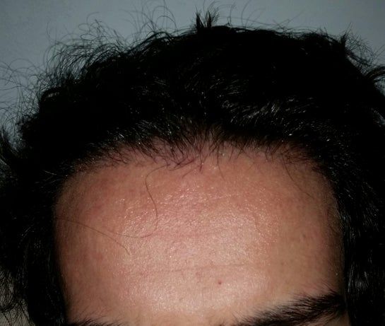 Cần bao nhiêu lâu để tóc mọc toàn bộ và có cần phải cắt tóc không? Cần bao nhiêu lâu để tóc mọc toàn bộ và có cần phải cắt tóc không?