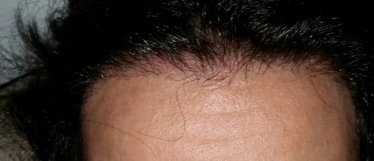 Cần bao nhiêu lâu để tóc mọc toàn bộ và có cần phải cắt tóc không? Cần bao nhiêu lâu để tóc mọc toàn bộ và có cần phải cắt tóc không?