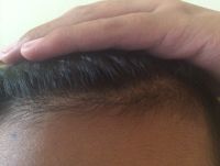 17 tuổi và bị rụng tóc, tại sao cháu bị rụng tóc nhiều hơn khi dùng thuốc?