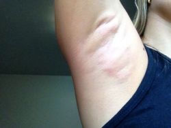 Vẫn sưng 1 tuần sau điều trị Miradry thì có bình thường không?