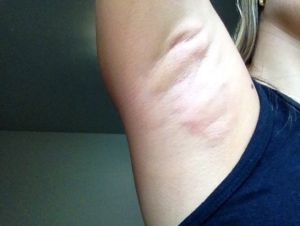 Vẫn sưng 1 tuần sau điều trị Miradry thì có bình thường không?