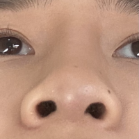 Mũi sưng mỗi khi thời tiết lạnh