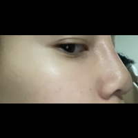 Mũi sưng mỗi khi thời tiết lạnh
