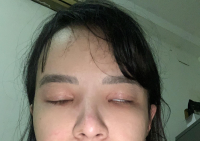 Hở mi, mắt trợn sau khi cắt mí