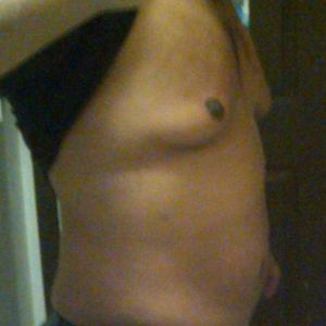 Nam giới muốn giảm mỡ bụng, ngực có nên làm đông hủy mỡ?