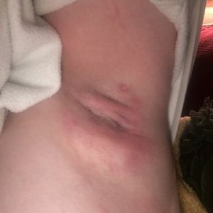 Ba tuần kể từ khi sử dụng MiraDry, nách lại nổi các cục u một lần nữa?