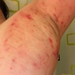 Điều trị bằng MiraDry chỉ một lần liệu có đủ, có lựa chọn gây tê nào khác không và tác dụng phụ lâu dài là gì?