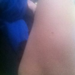 Cháu nên làm gì với da lỏng lẻo nhiều ở má đùi trong?