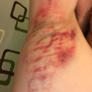 Điều trị bằng MiraDry chỉ một lần liệu có đủ, có lựa chọn gây tê nào khác không và tác dụng phụ lâu dài là gì?