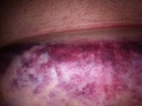 Bụng bị bầm tím, tụ máu nghiêm trọng sau khi làm đông hủy mỡ?