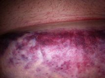 Bụng bị bầm tím, tụ máu nghiêm trọng sau khi làm đông hủy mỡ?