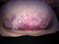 Bụng bị bầm tím, tụ máu nghiêm trọng sau khi làm đông hủy mỡ?