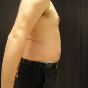 Tôi nên chọn Bella, Zerona hay đông hủy mỡ để giảm mỡ bụng?