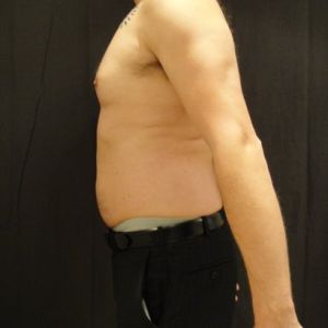 Tôi nên chọn Bella, Zerona hay đông hủy mỡ để giảm mỡ bụng?