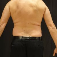 Tôi nên chọn Bella, Zerona hay đông hủy mỡ để giảm mỡ bụng?