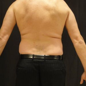 Tôi nên chọn Bella, Zerona hay đông hủy mỡ để giảm mỡ bụng?