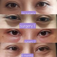 Cấy mỡ tự thân hốc mắt bị lỗi?