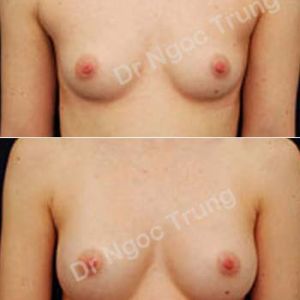 Nâng ngực Dr Ngọc Trung - ca 10