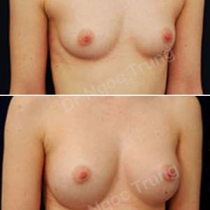 Nâng ngực Dr Ngọc Trung - ca 10