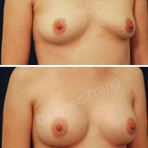 Nâng ngực Dr Ngọc Trung - Ca 11