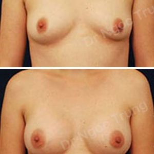 Nâng ngực Dr Ngọc Trung - Ca 11