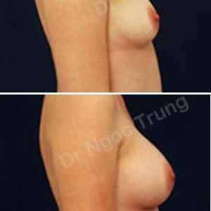 Nâng ngực Dr Ngọc Trung - Ca 11