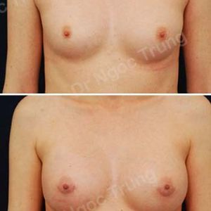 Nâng ngực Dr Ngọc Trung - Ca 13