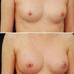 Nâng ngực Dr Ngọc Trung - Ca 13