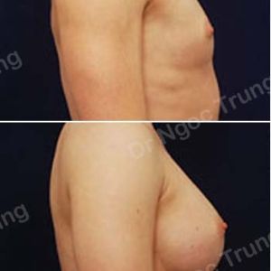Nâng ngực Dr Ngọc Trung - ca 14