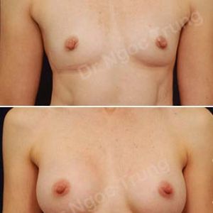 Nâng ngực Dr Ngọc Trung - Ca 15