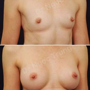 Nâng ngực Dr Ngọc Trung - Ca 15