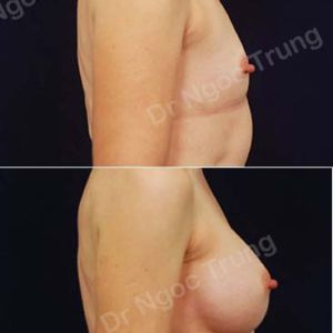 Nâng ngực Dr Ngọc Trung - Ca 15