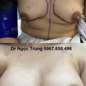 Nâng ngực Dr Ngọc Trung - Ca 2