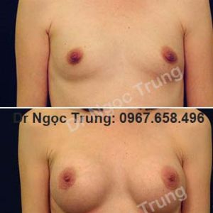Nâng ngực Dr Ngọc Trung - ca 9