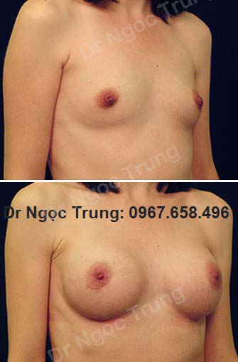 Nâng ngực Dr Ngọc Trung - ca 9