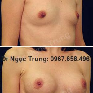 Nâng ngực Dr Ngọc Trung - ca 9