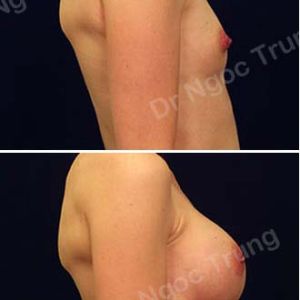 Nâng ngực Dr Ngọc Trung - ca 9
