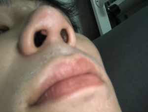 Trong mũi lòi ra 1 cục sau phẫu thuật