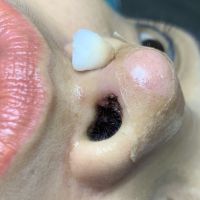 Bị đóng dịch ở vết khâu