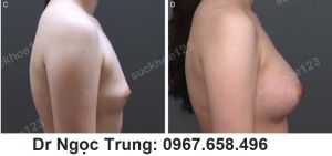 Nâng ngực bằng túi gel Mentor 320 cc, nữ 28 tuổi - ca 3