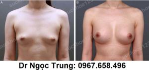 Nâng ngực bằng túi gel Mentor 320 cc, nữ 28 tuổi - ca 3